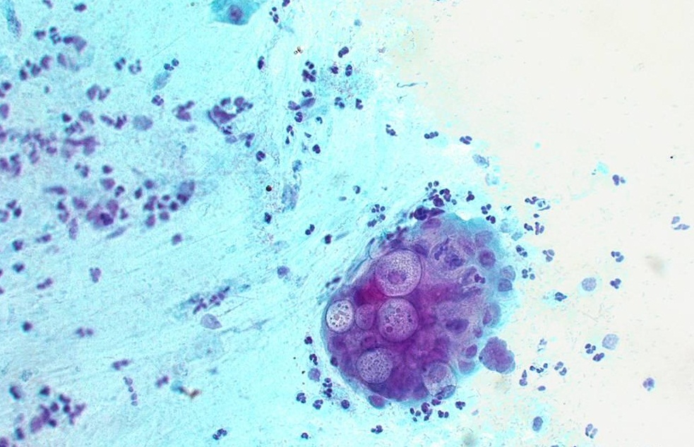 Vi khuẩn Chlamydia trachomatis gây viêm tinh hoàn