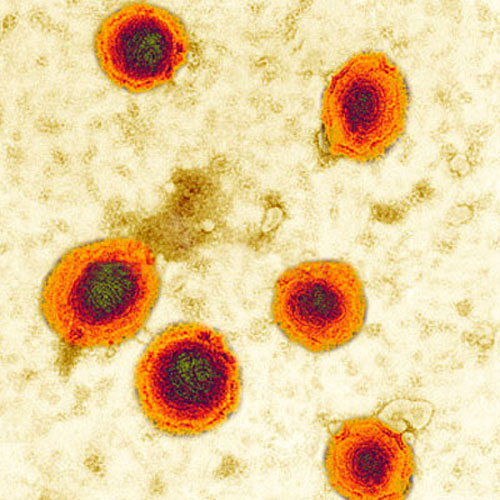 virus Paramyxovirus  gây quai bị biến chứng viêm tinh hoàn